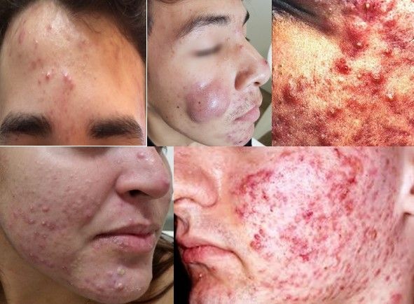 Tratamento de Acne